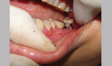 cosmetic dentistry treatment in Anand
                        